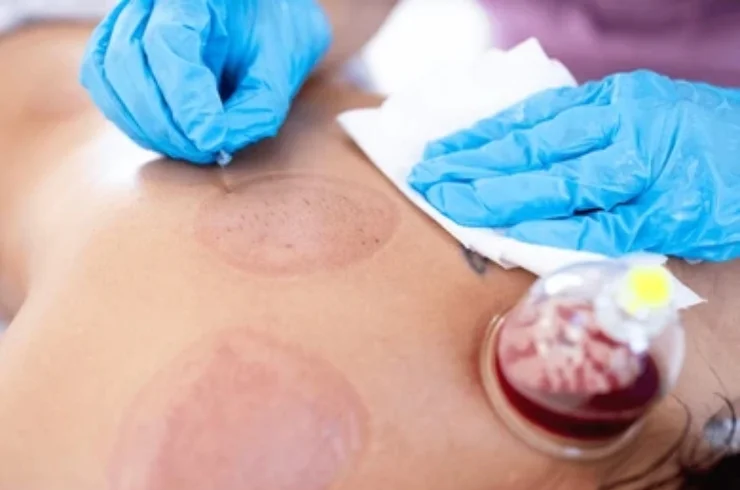 Hijama Cupping-----11