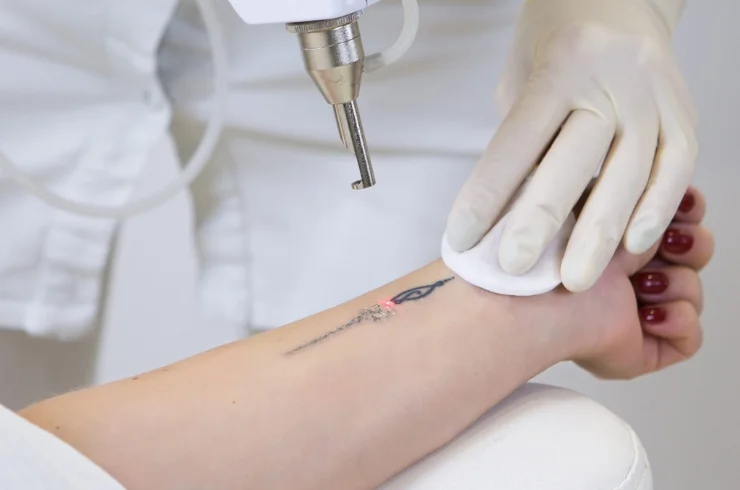 Tattoo Removal------11